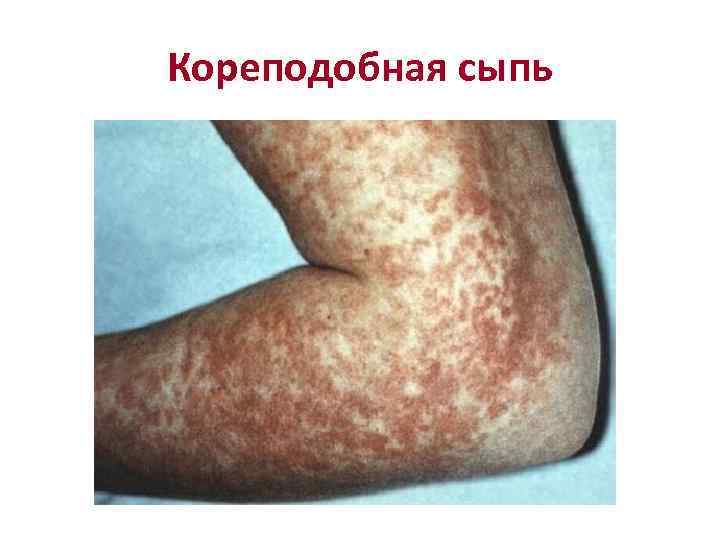 Кореподобная сыпь 