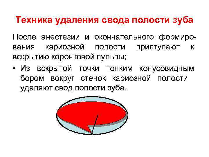 Техника удаления свода полости зуба После анестезии и окончательного формирования кариозной полости приступают к