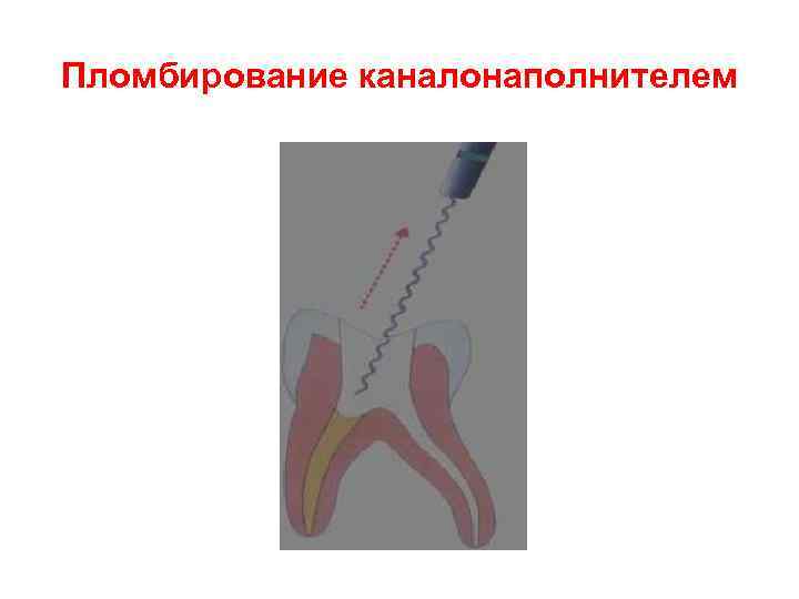 Пломбирование каналонаполнителем 