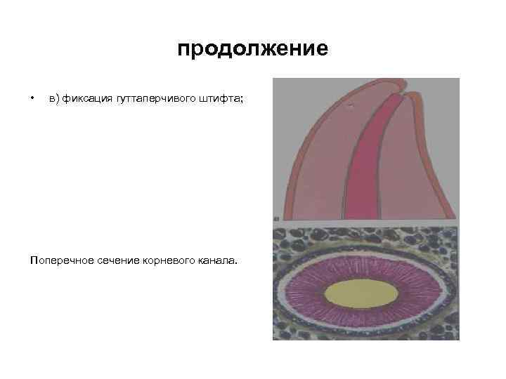 продолжение • в) фиксация гуттаперчивого штифта; Поперечное сечение корневого канала. 
