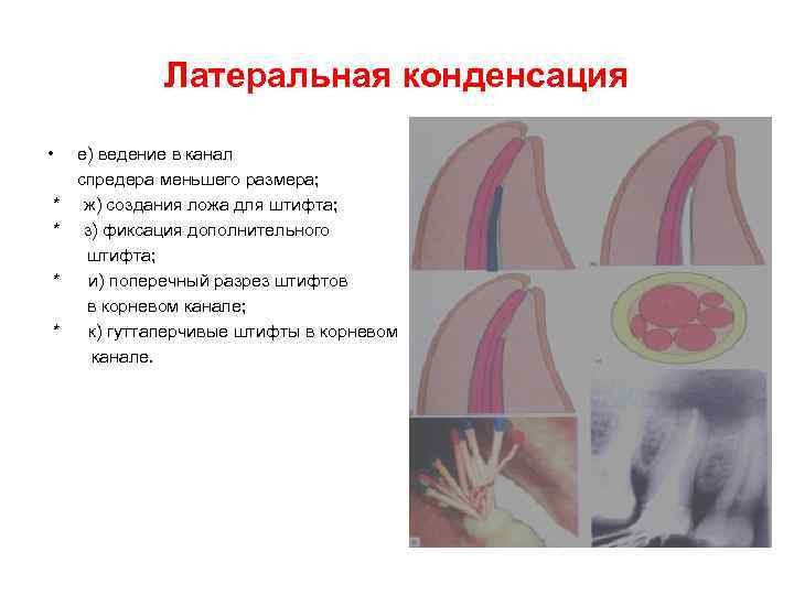 Латеральная конденсация • * * е) ведение в канал спредера меньшего размера; ж) создания