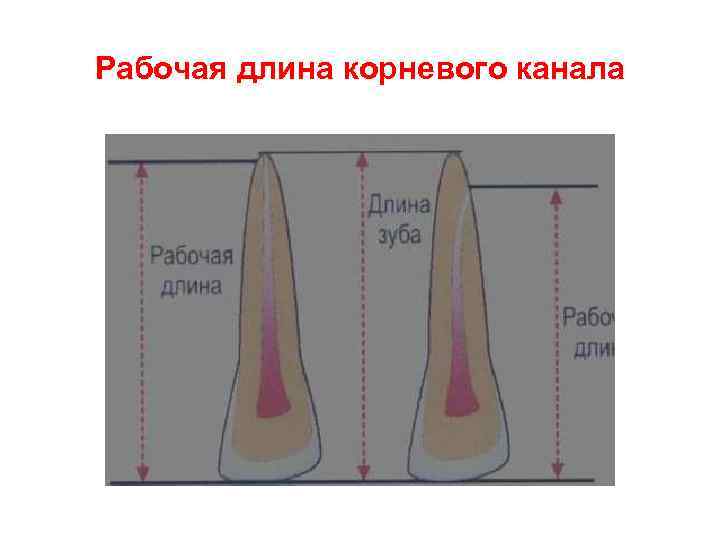 Рабочая длина корневого канала 