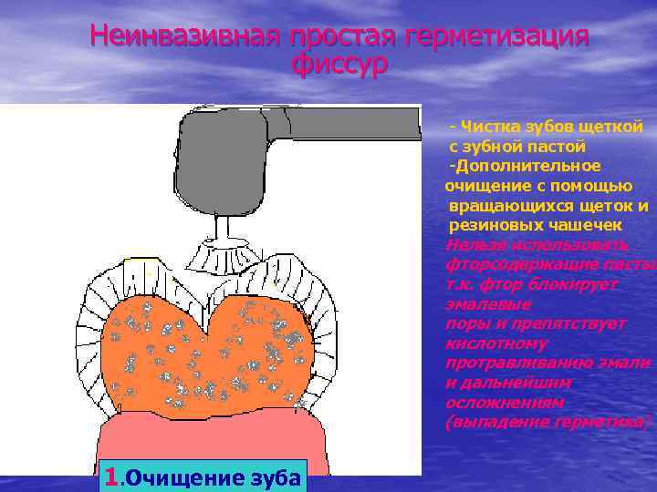 Неинвазивная простая герметизация фиссур - Чистка зубов щеткой с зубной пастой -Дополнительное очищение с