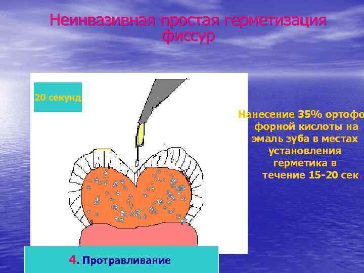 Неинвазивная простая герметизация фиссур 20 секунд Нанесение 35% ортофо форной кислоты на эмаль зуба
