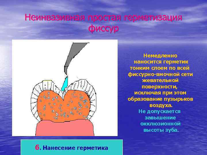 Неинвазивная простая герметизация фиссур Немедленно наносится герметик тонким слоем по всей фиссурно-ямочной сети жевательной