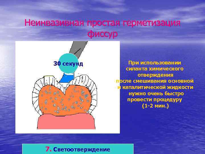 Неинвазивная простая герметизация фиссур 30 секунд 7. Светоотверждение При использовании силанта химического отверждения после