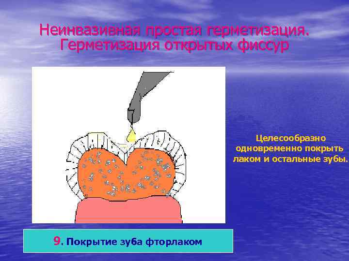 Неинвазивная простая герметизация. Герметизация открытых фиссур Целесообразно одновременно покрыть лаком и остальные зубы. 9.