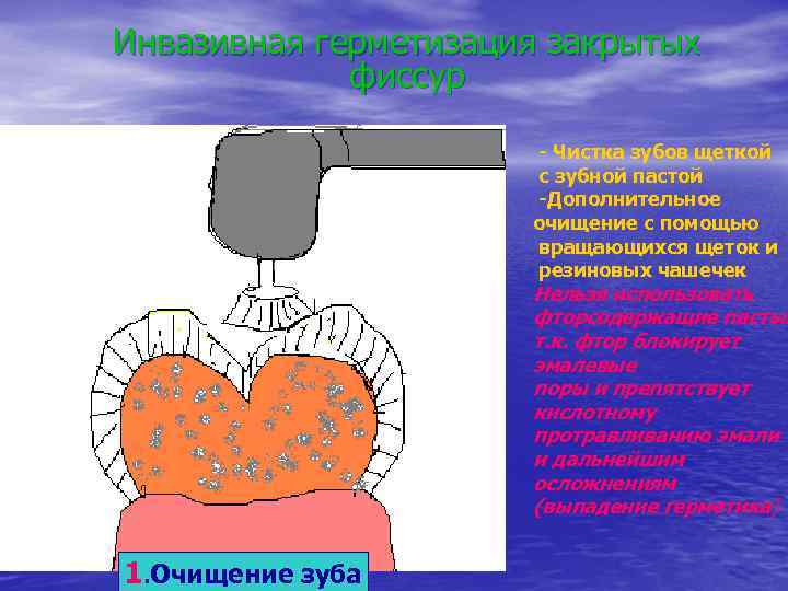 Инвазивная герметизация закрытых фиссур - Чистка зубов щеткой с зубной пастой -Дополнительное очищение с