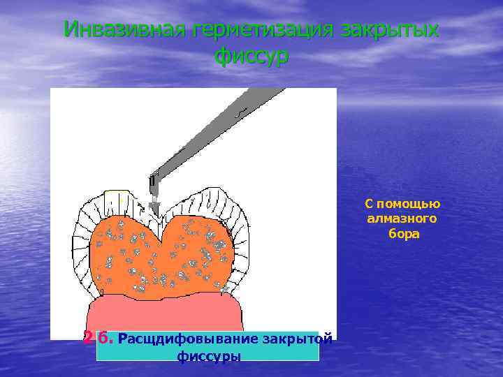Инвазивная герметизация закрытых фиссур С помощью алмазного бора 2 б. Расщдифовывание закрытой фиссуры 