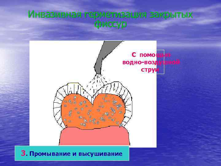 Инвазивная герметизация закрытых фиссур С помощью водно-воздушной струи 3. Промывание и высушивание 