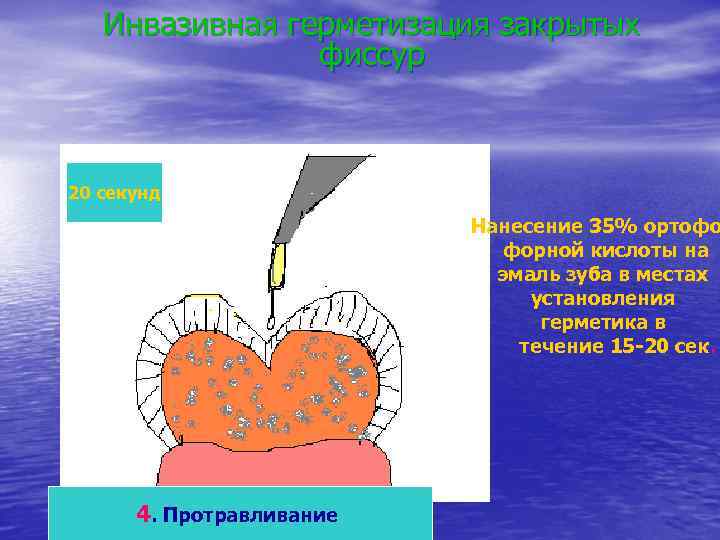 Инвазивная герметизация закрытых фиссур 20 секунд Нанесение 35% ортофо форной кислоты на эмаль зуба