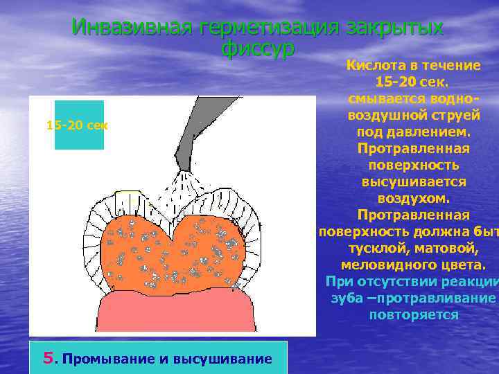 Инвазивная герметизация закрытых фиссур 15 -20 сек. 5. Промывание и высушивание Кислота в течение