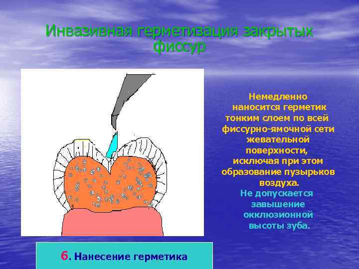 Инвазивная герметизация закрытых фиссур Немедленно наносится герметик тонким слоем по всей фиссурно-ямочной сети жевательной