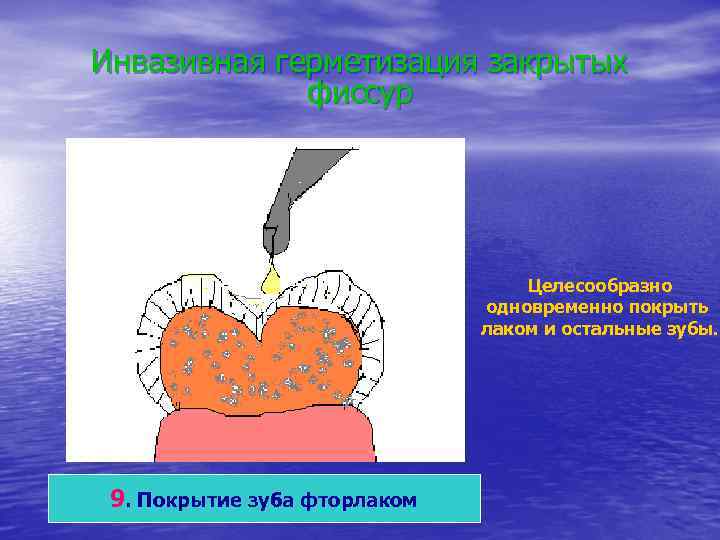 Инвазивная герметизация закрытых фиссур Целесообразно одновременно покрыть лаком и остальные зубы. 9. Покрытие зуба