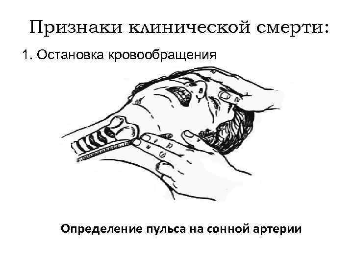 Признаки клинической смерти: 1. Остановка кровообращения Определение пульса на сонной артерии 