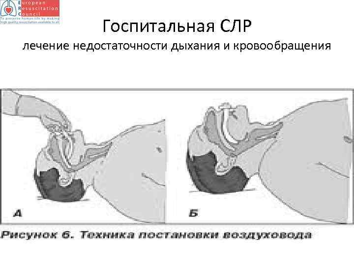 Госпитальная СЛР лечение недостаточности дыхания и кровообращения 
