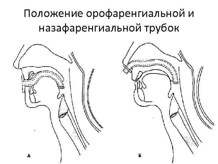 Положение орофаренгиальной и назафаренгиальной трубок 