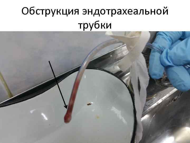 Обструкция эндотрахеальной трубки 