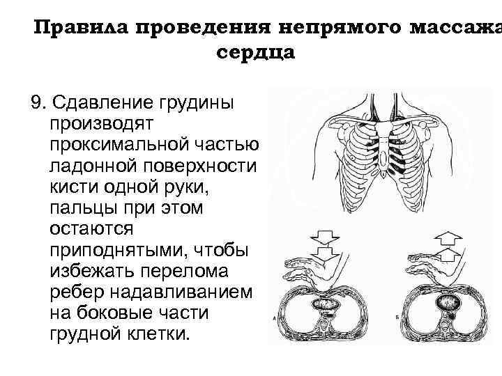 Правила проведения непрямого массажа сердца 9. Сдавление грудины производят проксимальной частью ладонной поверхности кисти