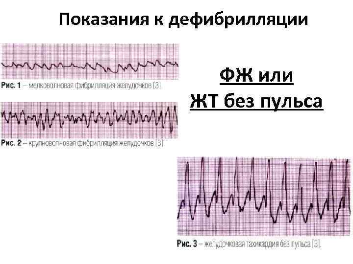 Показания к дефибрилляции ФЖ или ЖТ без пульса 