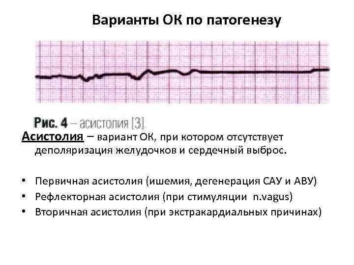 Варианты ОК по патогенезу Асистолия – вариант ОК, при котором отсутствует деполяризация желудочков и