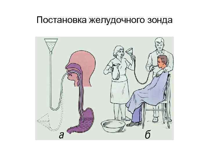 Постановка желудочного зонда 