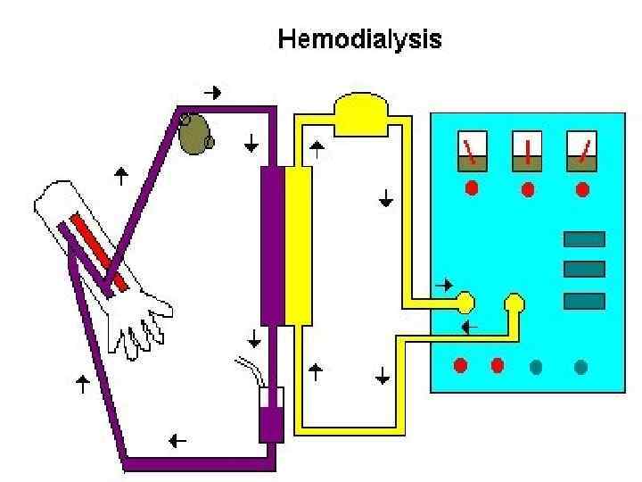 Схема гемодиализа 