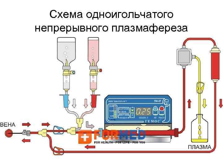 Схема одноигольчатого непрерывного плазмафереза 