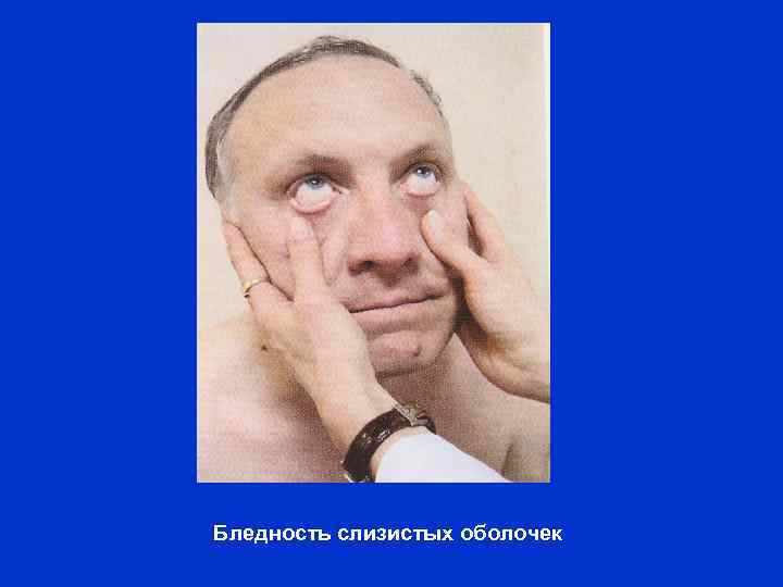 Бледность слизистых оболочек 