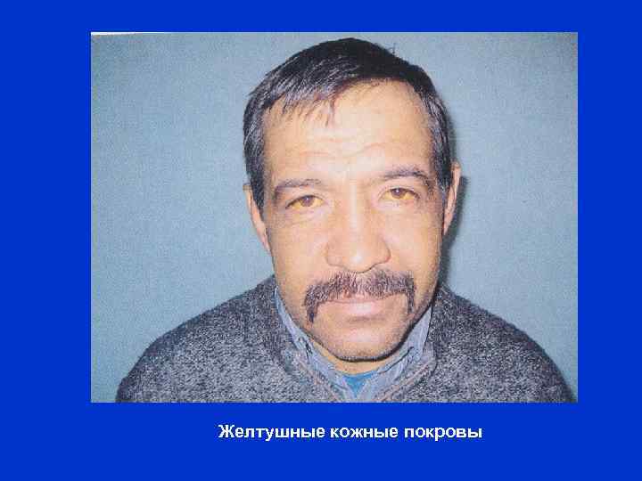 Желтушные кожные покровы 