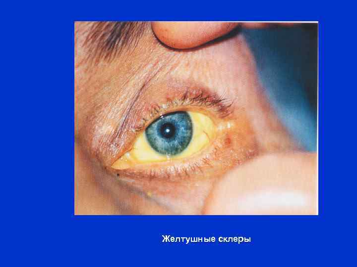 Желтушные склеры 
