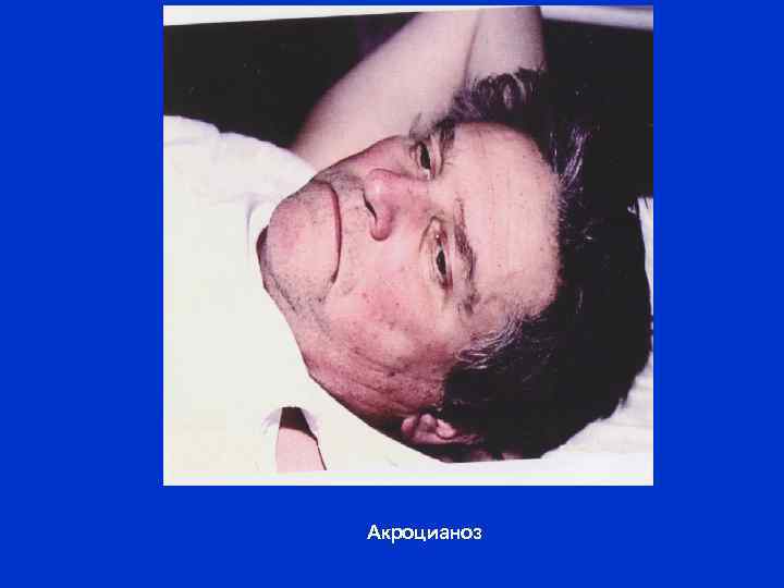 Акроцианоз 