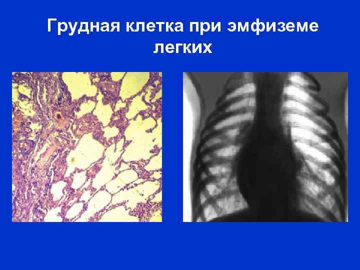 Грудная клетка при эмфиземе легких 