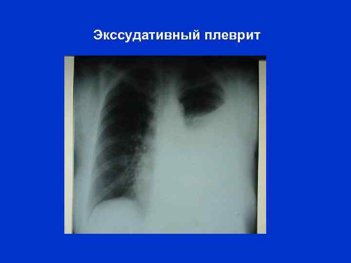 Экссудативный плеврит 