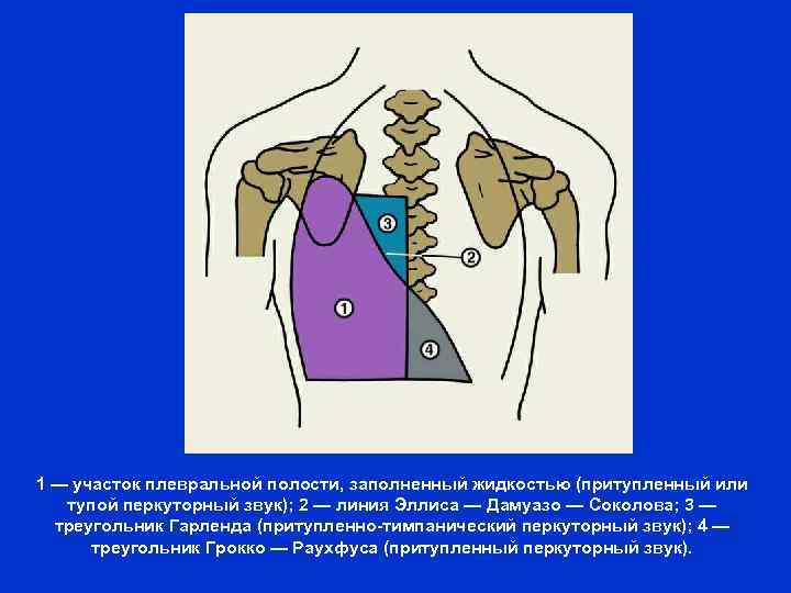 1 — участок плевральной полости, заполненный жидкостью (притупленный или тупой перкуторный звук); 2 —