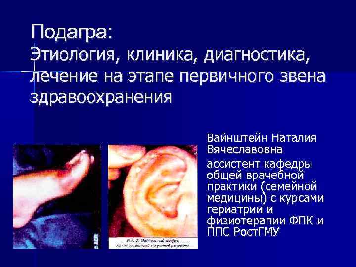 Подагра: Этиология, клиника, диагностика, лечение на этапе первичного звена здравоохранения Вайнштейн Наталия Вячеславовна ассистент