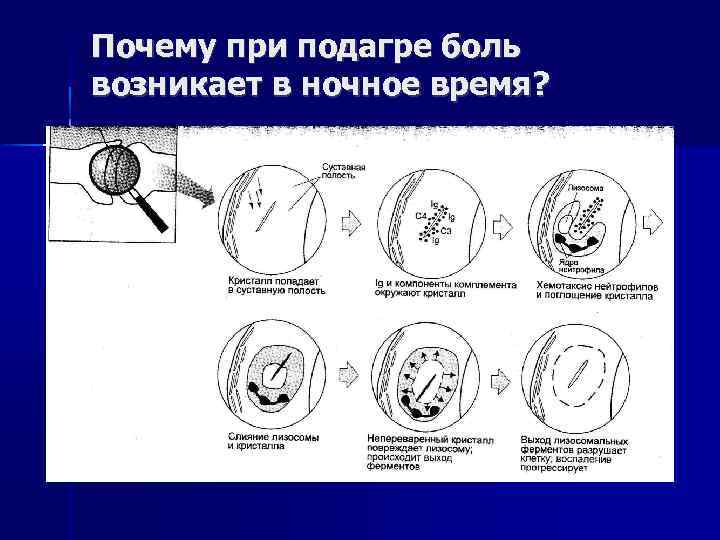 Почему при подагре боль возникает в ночное время? 