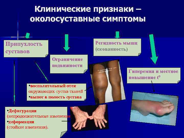 Клинические признаки – околосуставные симптомы Регидность мышц (скованность) Припухлость суставов Ограничение подвижности Гиперемия и