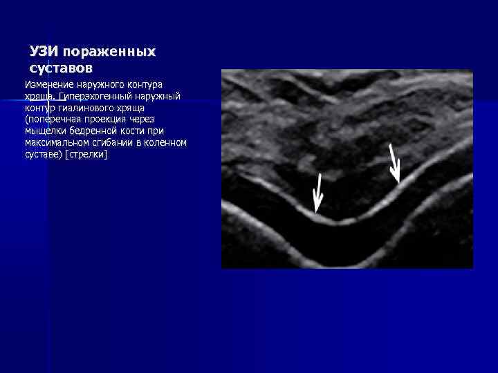 Адрес узи суставов. Норма гиалинового хряща коленного сустава УЗИ. Ультразвуковые признаки подагры. Двойной контур при подагре УЗИ.