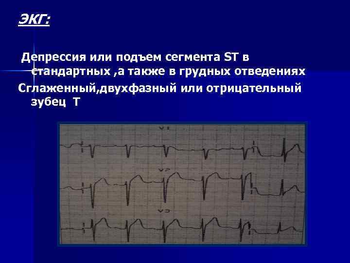 ЭКГ: Депрессия или подъем сегмента ST в стандартных , а также в грудных отведениях