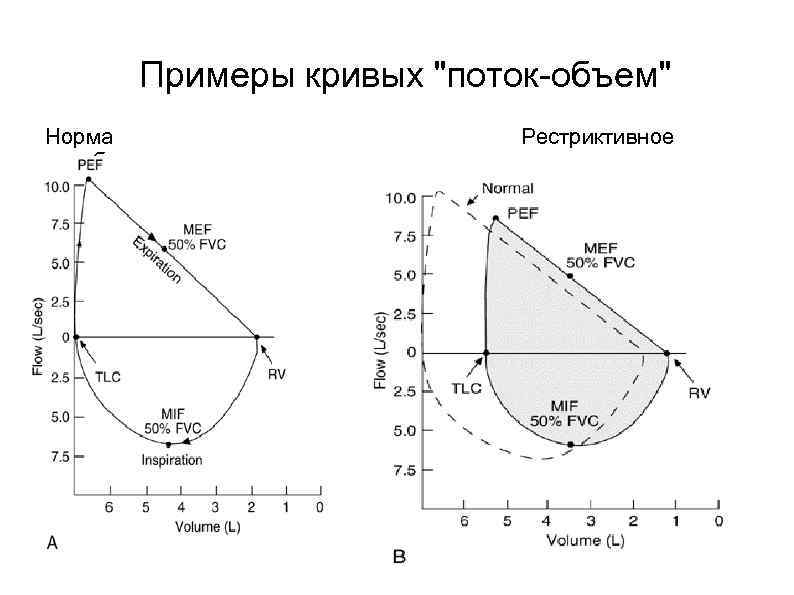 Примеры кривых. Рестриктивный Тип дыхательной недостаточности спирограмма. Кривые поток-объем при бронхиальной астме. Петля поток объем при бронхиальной астме. Кривая поток объем при бронхиальной астме.