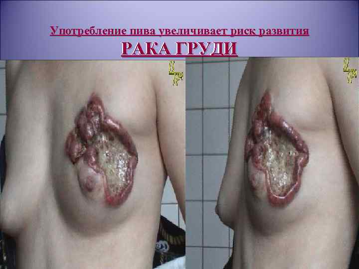 Употребление пива увеличивает риск развития РАКА ГРУДИ 
