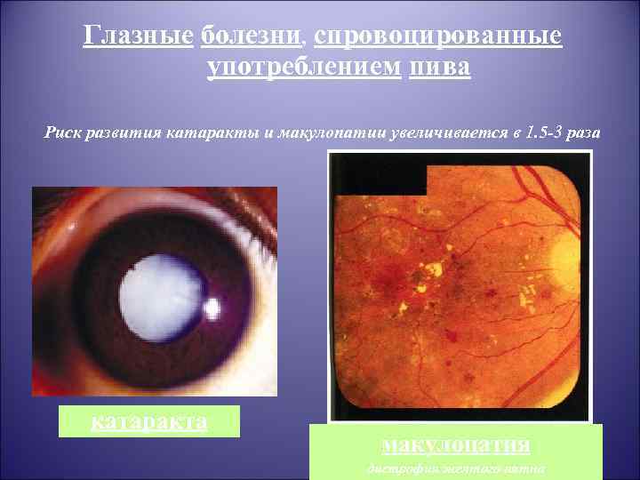 Глазные болезни, спровоцированные употреблением пива Риск развития катаракты и макулопатии увеличивается в 1. 5
