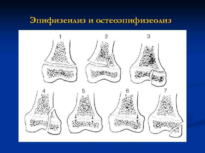 Эпифизеилиз и остеоэпифизеолиз 