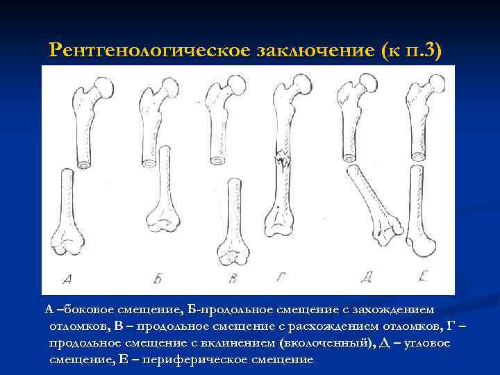 Рентгенологическое заключение (к п. 3) А –боковое смещение, Б-продольное смещение с захождением отломков, В