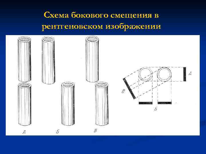 Латеральное смещение. Схема боковая. Потери, связанные с боковым смещением сердцевин. Немедленное боковое смещение. Рентгенографический рисунок пикетаж макаронные рисунки что общего?.