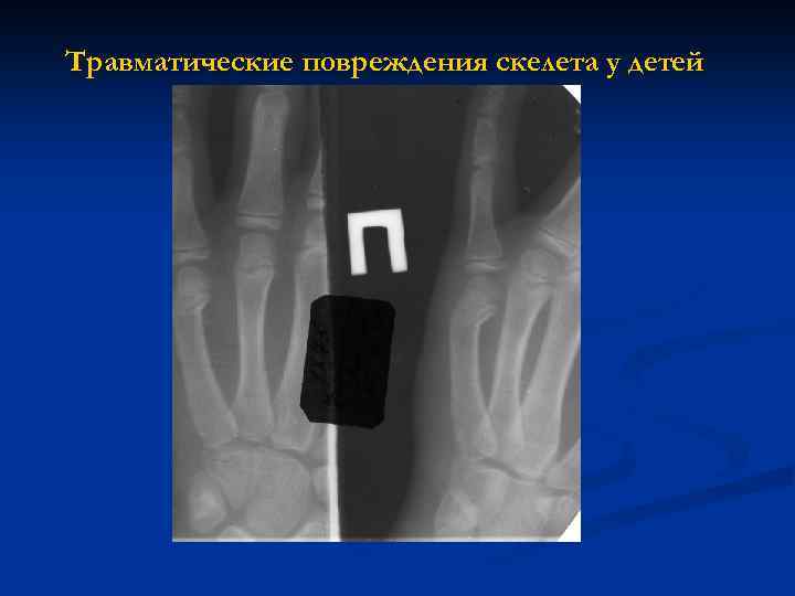 Травматические повреждения скелета у детей 
