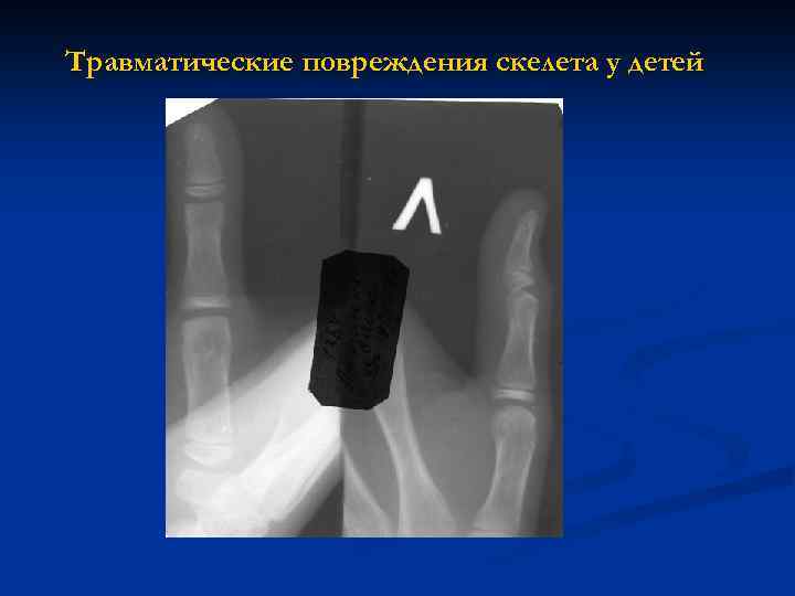 Травматические повреждения скелета у детей 