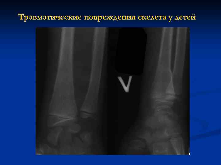Травматические повреждения скелета у детей 