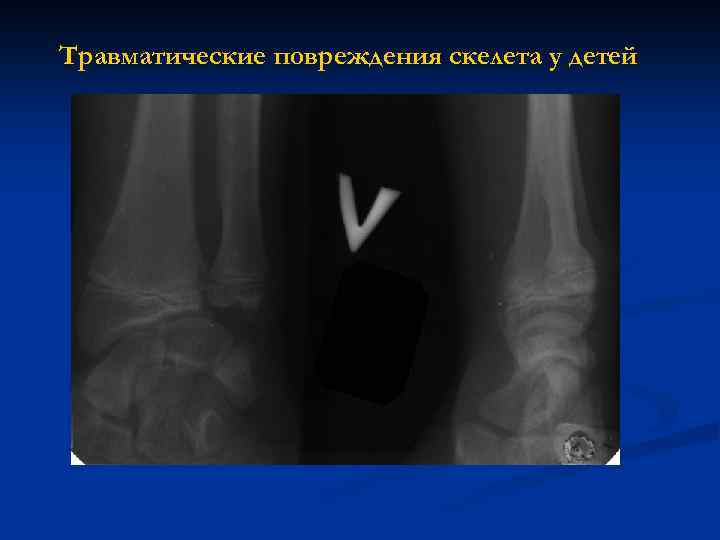 Травматические повреждения скелета у детей 